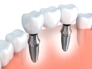 Tooth human implant (done in 3d graphics)
